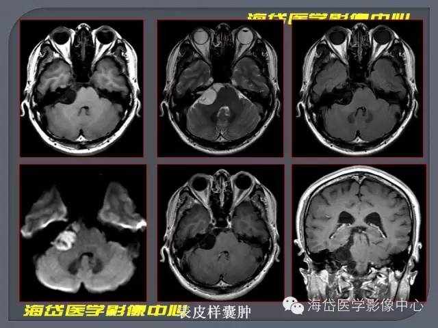 【PPT】基于MR增强扫描的桥小脑角区病变的影像学诊断