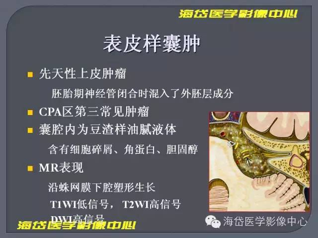 【PPT】基于MR增强扫描的桥小脑角区病变的影像学诊断