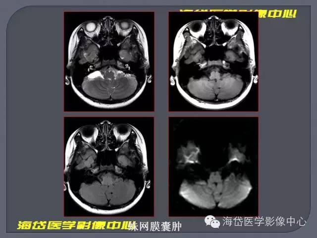 【PPT】基于MR增强扫描的桥小脑角区病变的影像学诊断