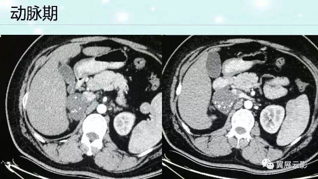 【病例】肾上腺神经鞘瘤1例CT影像