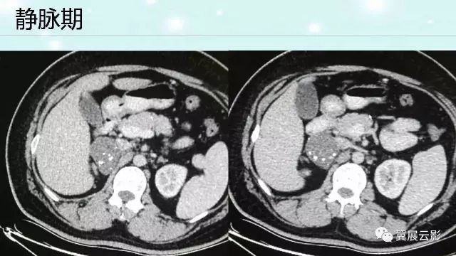 【病例】肾上腺神经鞘瘤1例CT影像