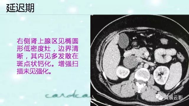 【病例】肾上腺神经鞘瘤1例CT影像