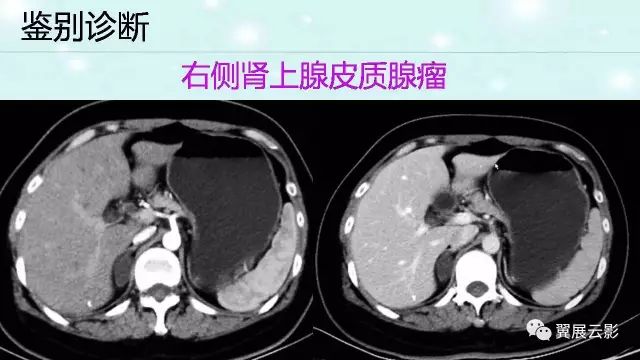 【病例】肾上腺神经鞘瘤1例CT影像