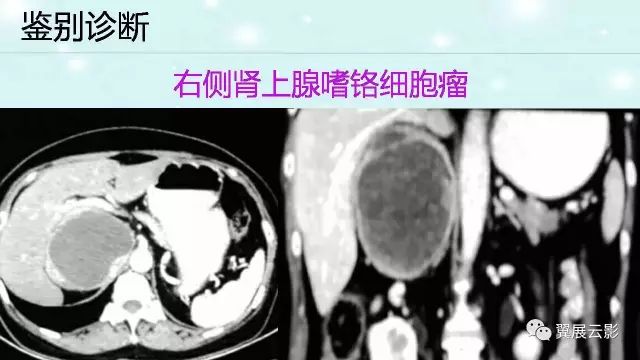 【病例】肾上腺神经鞘瘤1例CT影像
