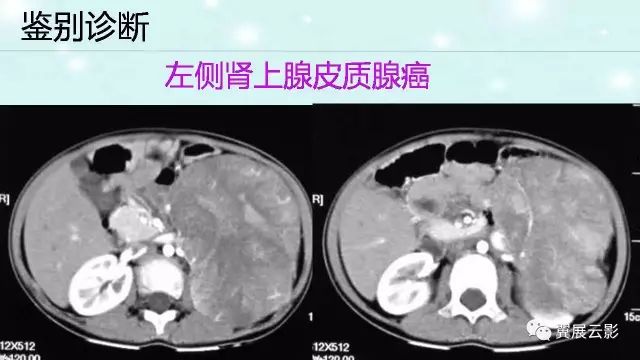 【病例】肾上腺神经鞘瘤1例CT影像