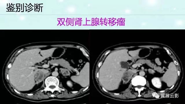 【病例】肾上腺神经鞘瘤1例CT影像