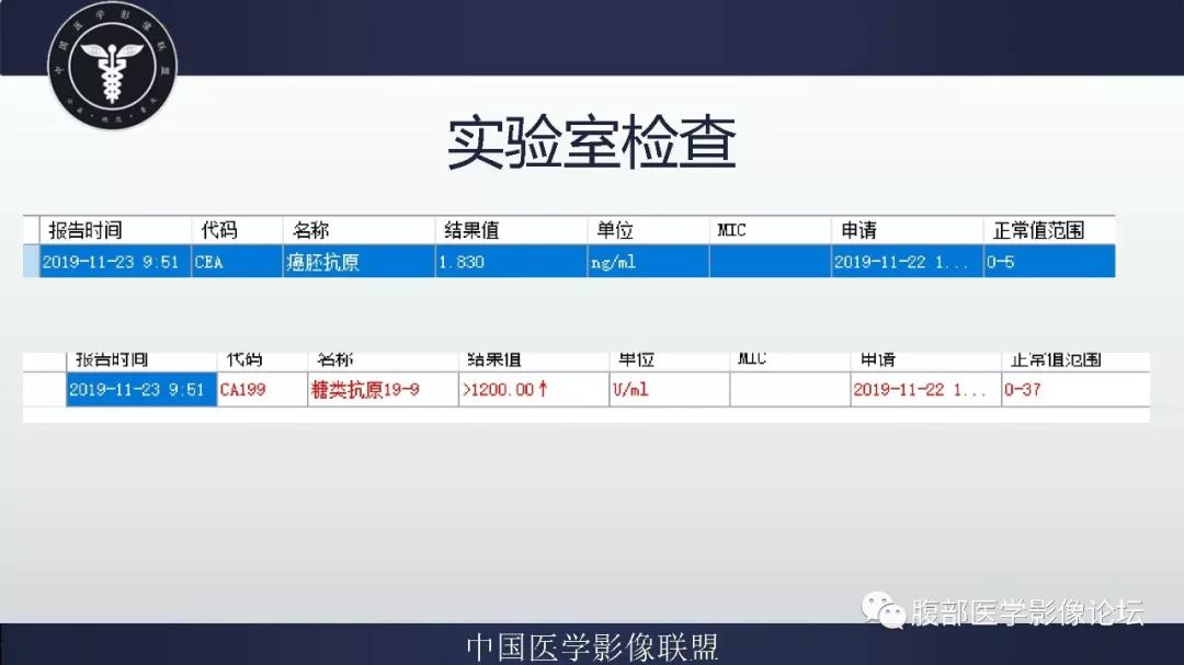 【病例】胆囊癌1例CT漏诊分析