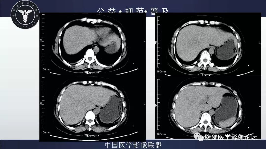【病例】胆囊癌1例CT漏诊分析