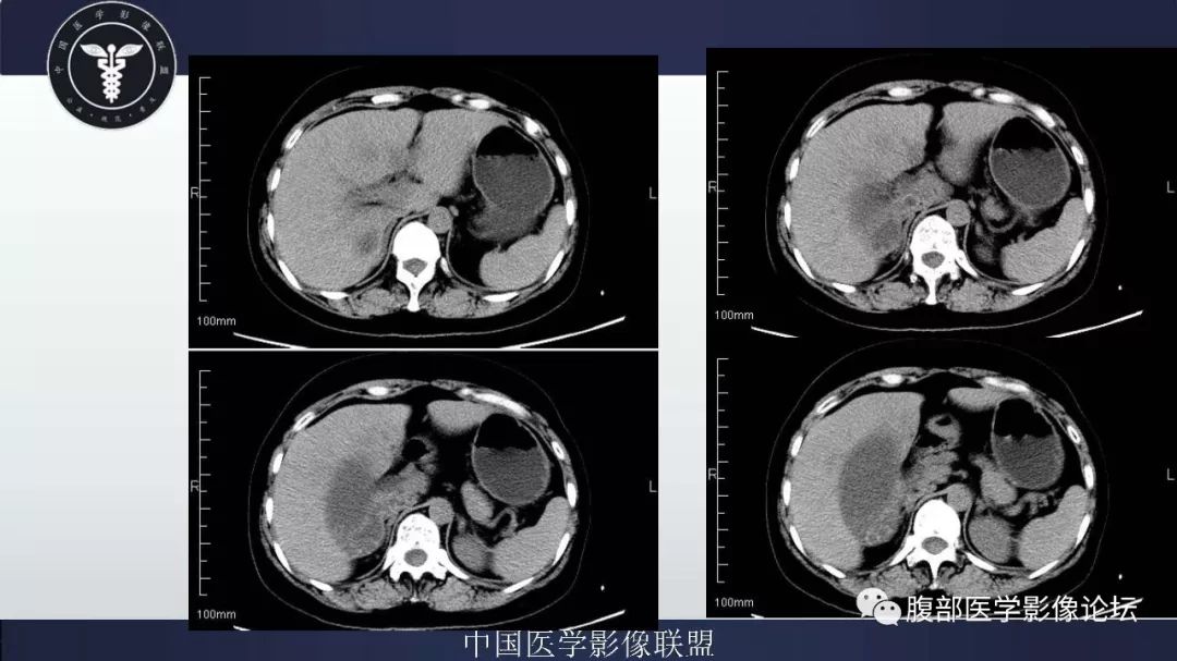 【病例】胆囊癌1例CT漏诊分析