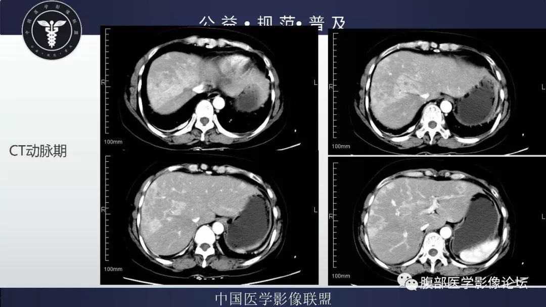 【病例】胆囊癌1例CT漏诊分析