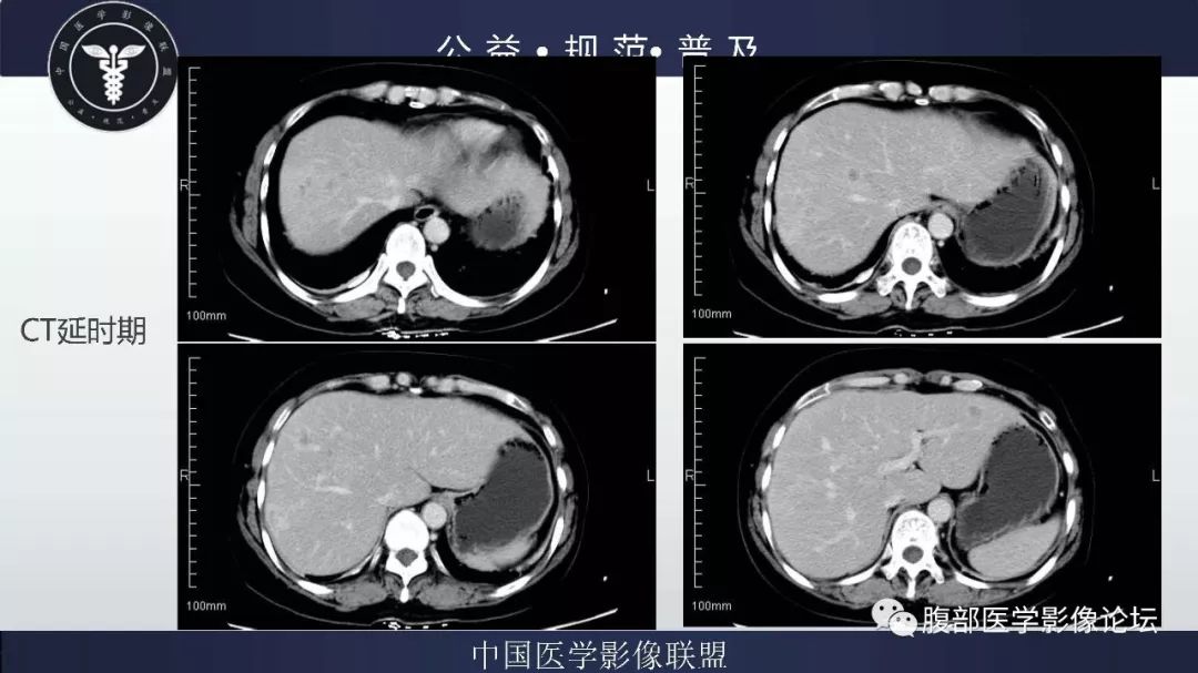 【病例】胆囊癌1例CT漏诊分析