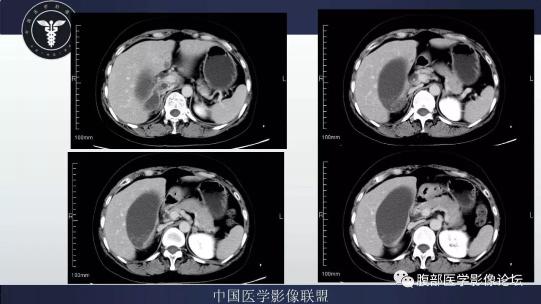 【病例】胆囊癌1例CT漏诊分析