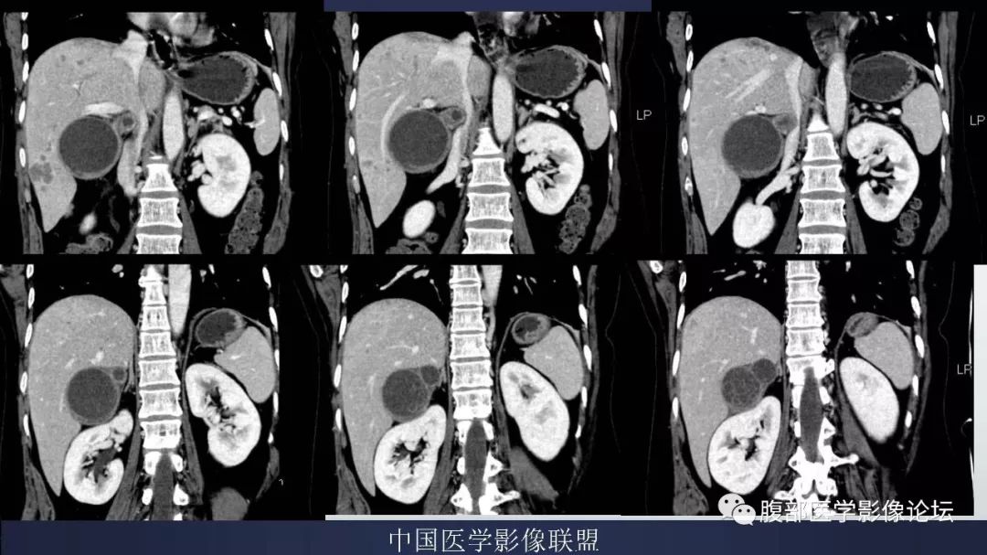 【病例】胆囊癌1例CT漏诊分析