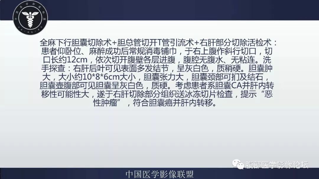 【病例】胆囊癌1例CT漏诊分析