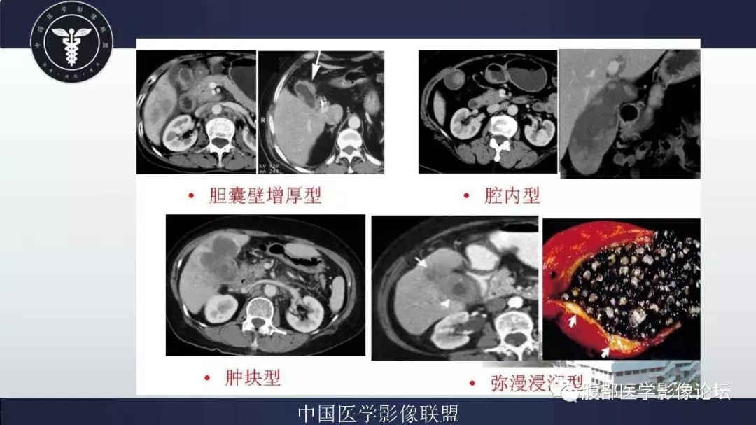 【病例】胆囊癌1例CT漏诊分析