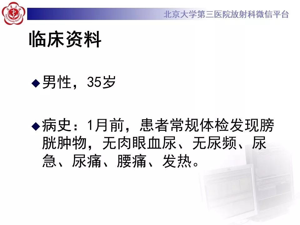 【PPT】膀胱平滑肌瘤