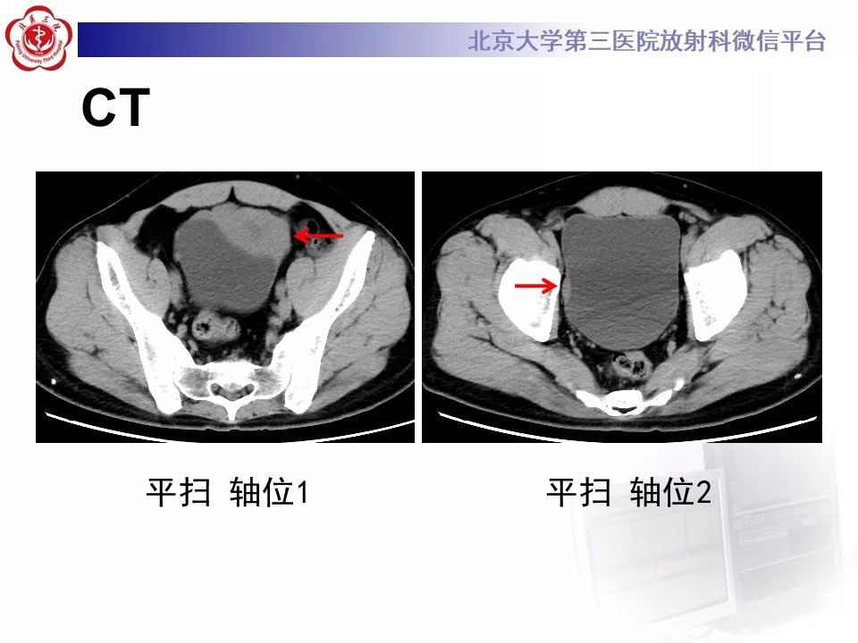 【PPT】膀胱平滑肌瘤