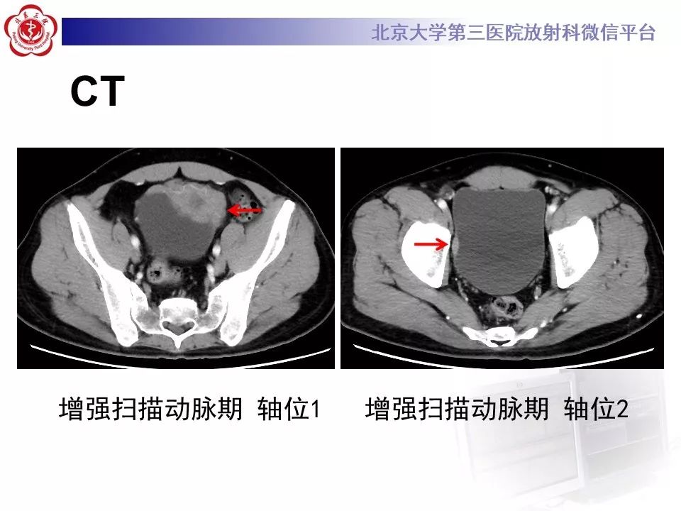 【PPT】膀胱平滑肌瘤