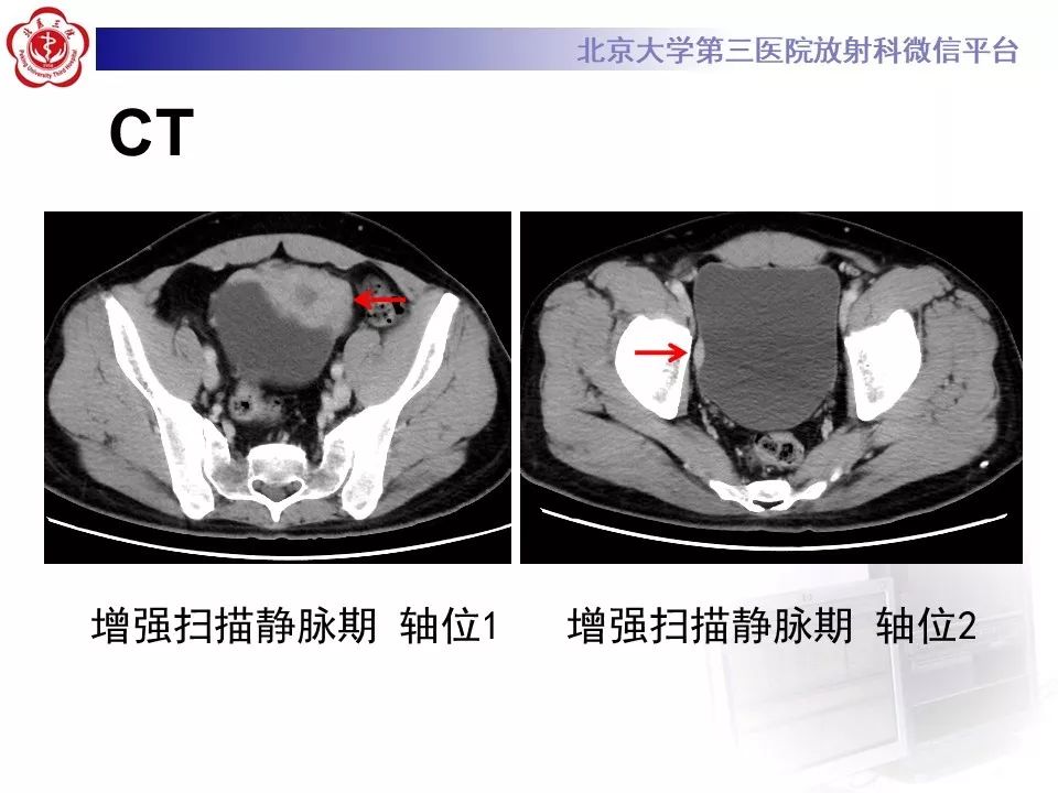 【PPT】膀胱平滑肌瘤