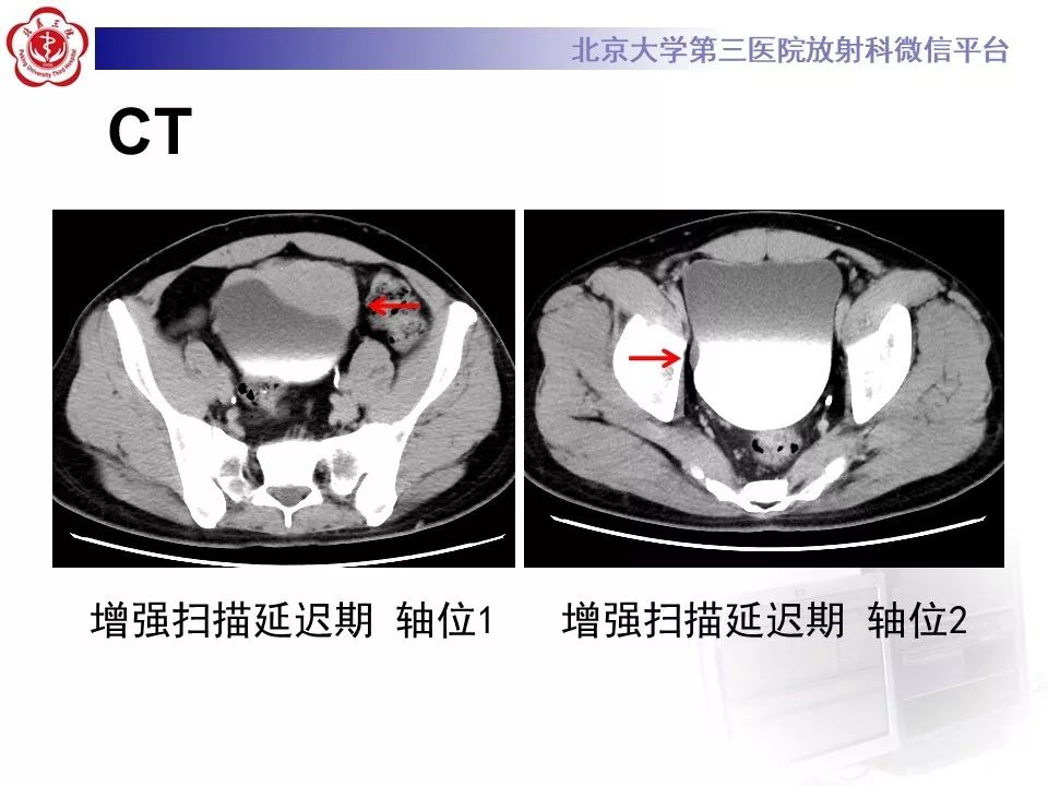 【PPT】膀胱平滑肌瘤