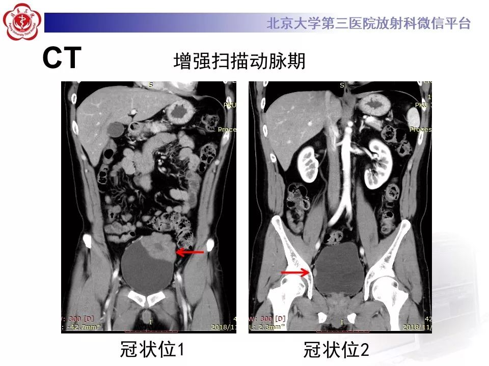 【PPT】膀胱平滑肌瘤