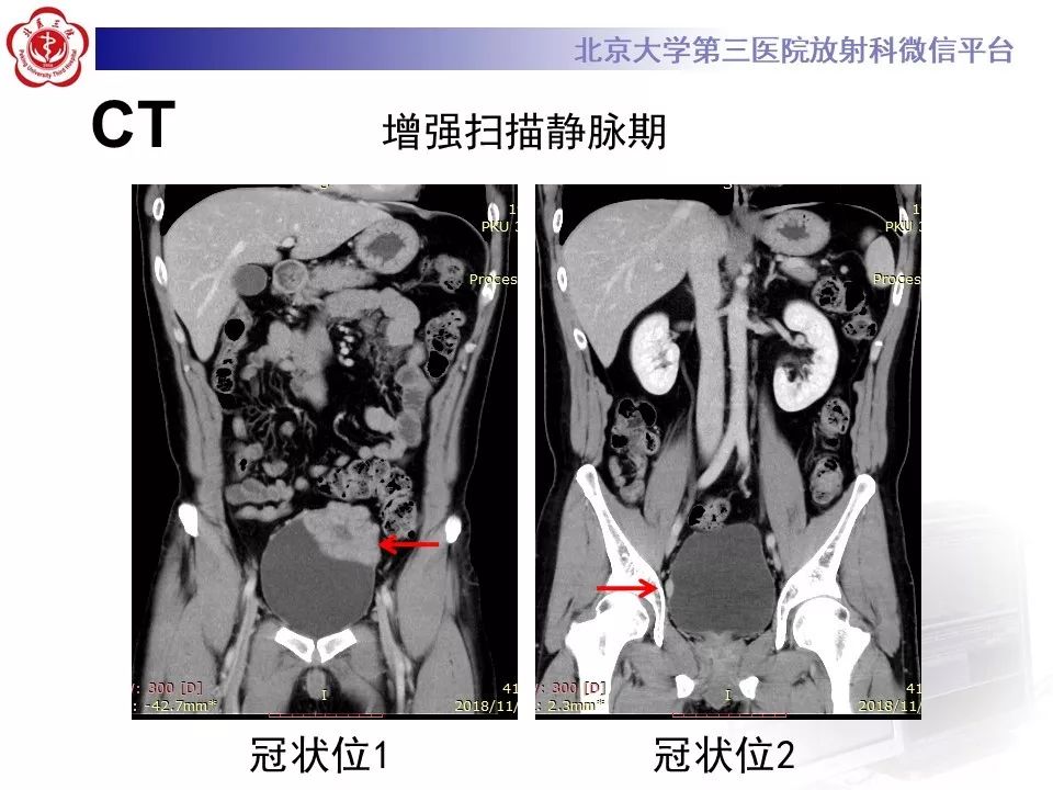 【PPT】膀胱平滑肌瘤
