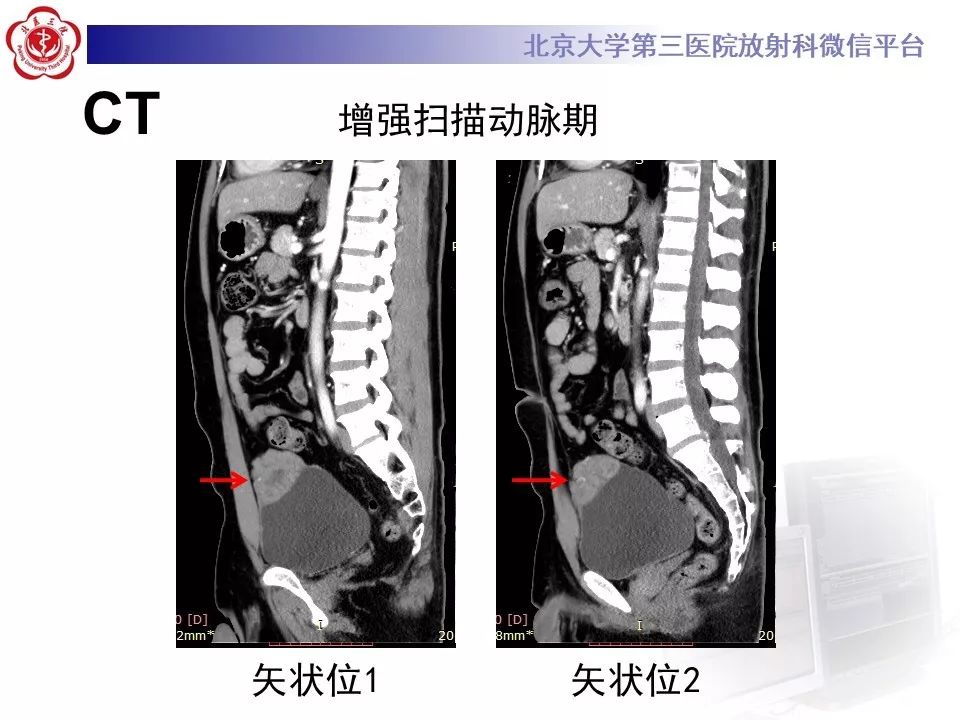 【PPT】膀胱平滑肌瘤