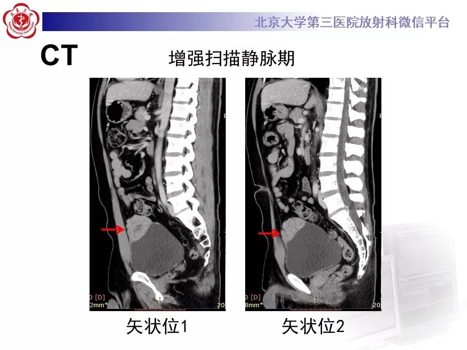 【PPT】膀胱平滑肌瘤