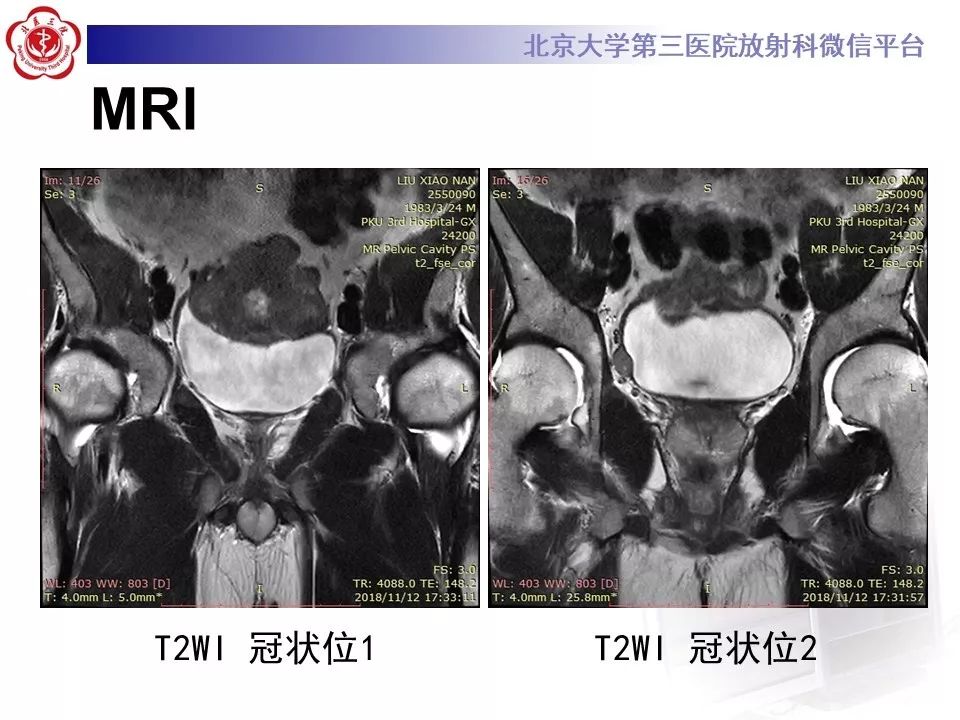 【PPT】膀胱平滑肌瘤