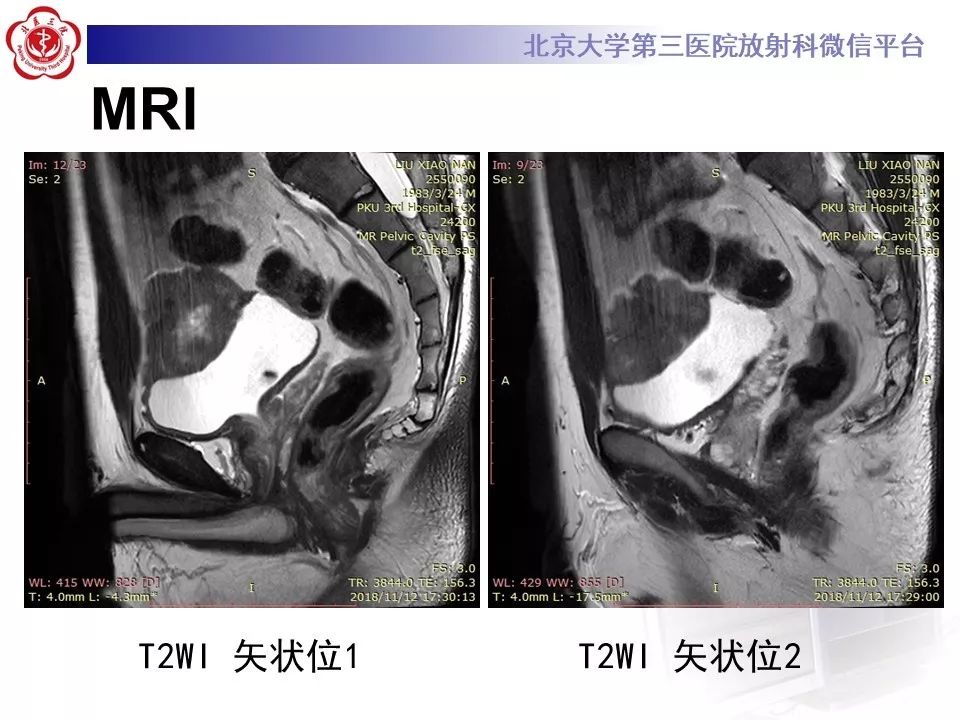 【PPT】膀胱平滑肌瘤