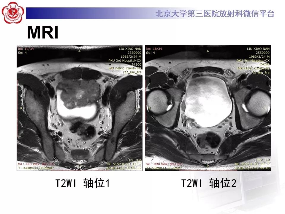 【PPT】膀胱平滑肌瘤