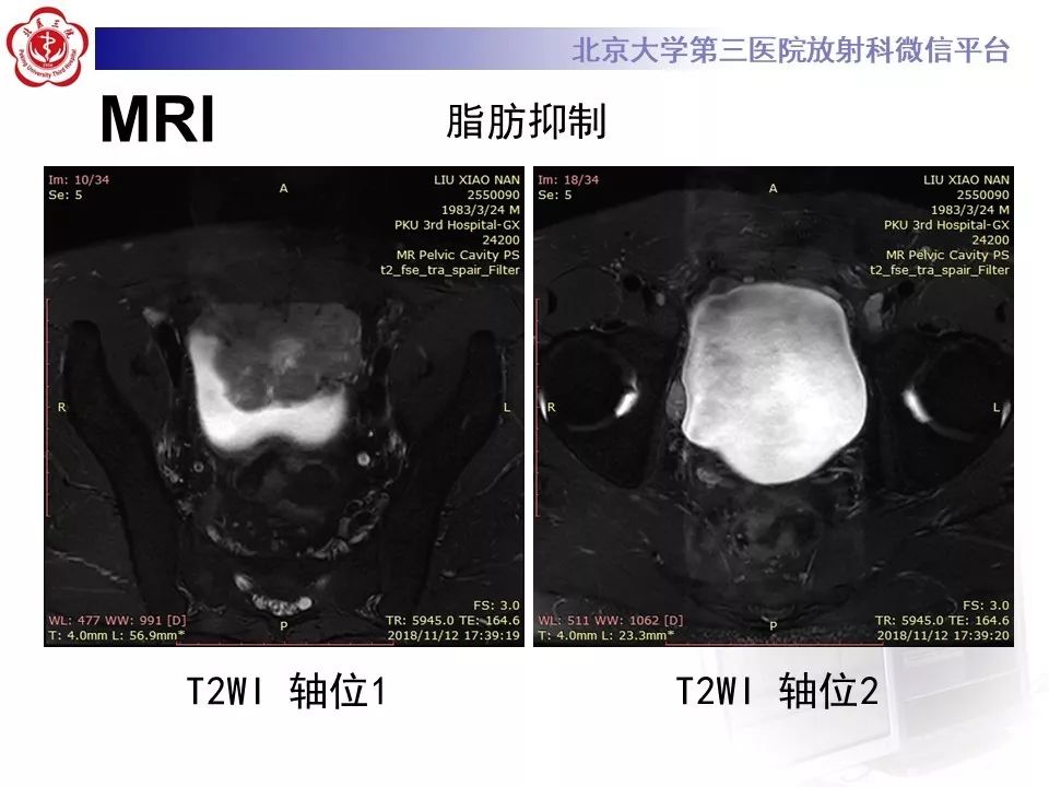 【PPT】膀胱平滑肌瘤