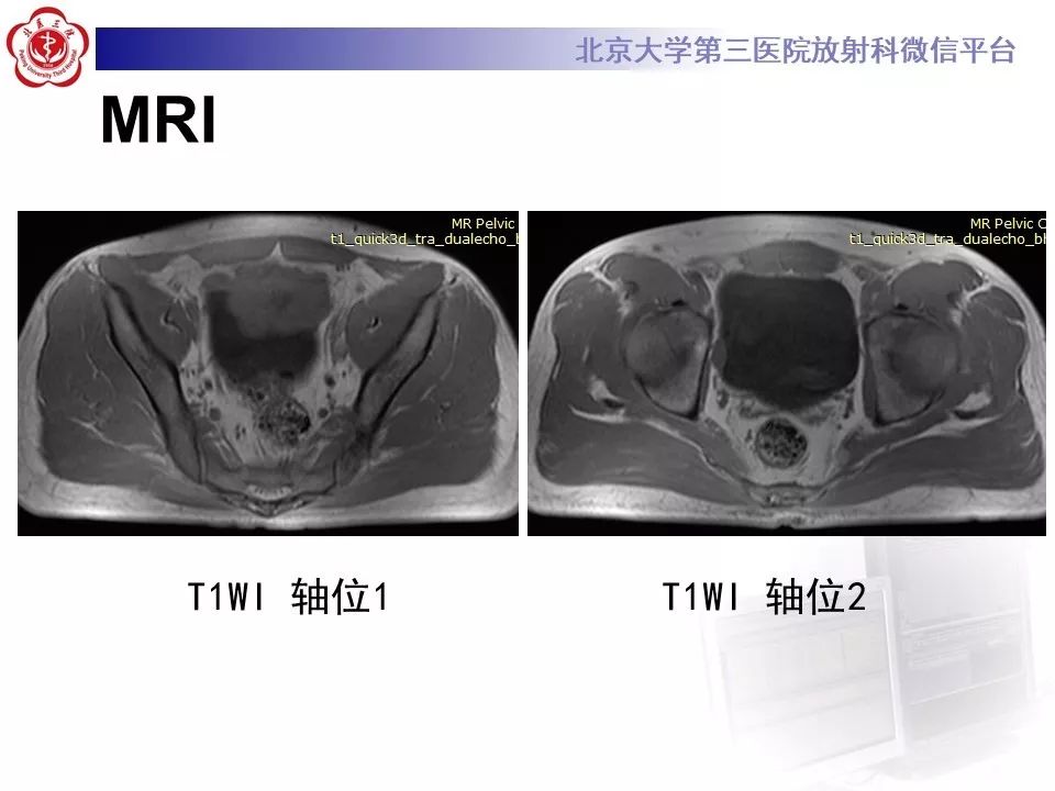 【PPT】膀胱平滑肌瘤