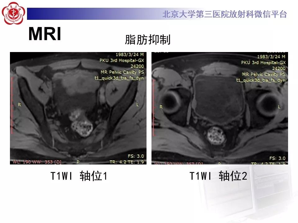 【PPT】膀胱平滑肌瘤