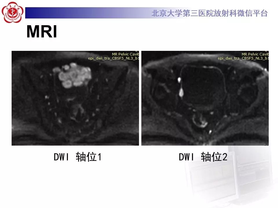 【PPT】膀胱平滑肌瘤