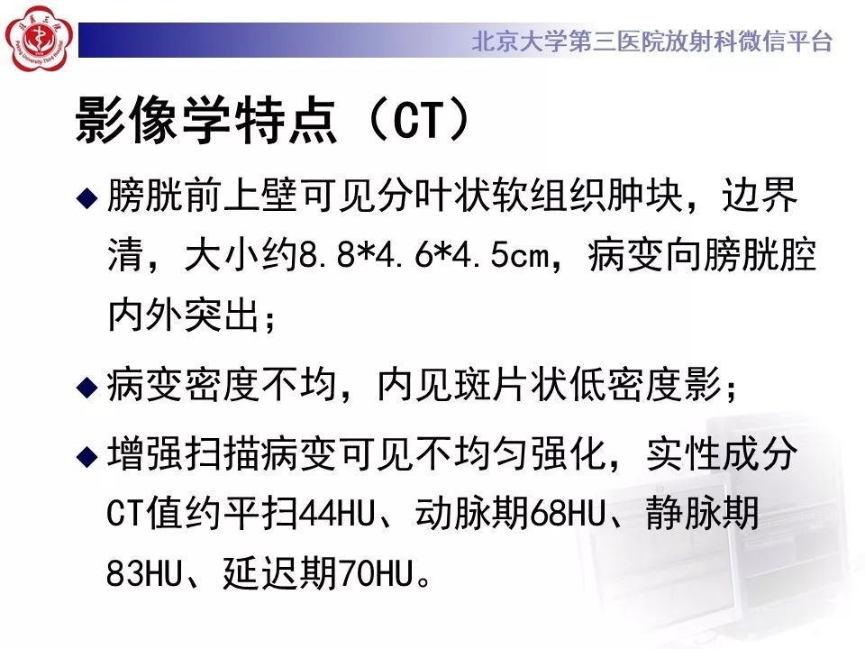 【PPT】膀胱平滑肌瘤