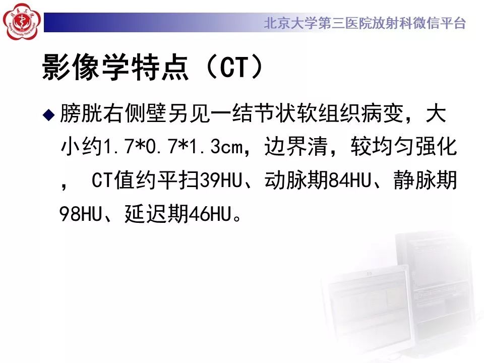 【PPT】膀胱平滑肌瘤