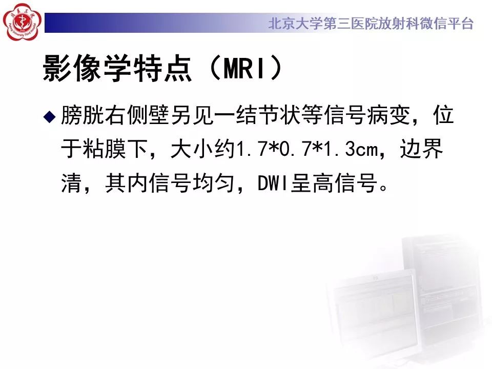 【PPT】膀胱平滑肌瘤