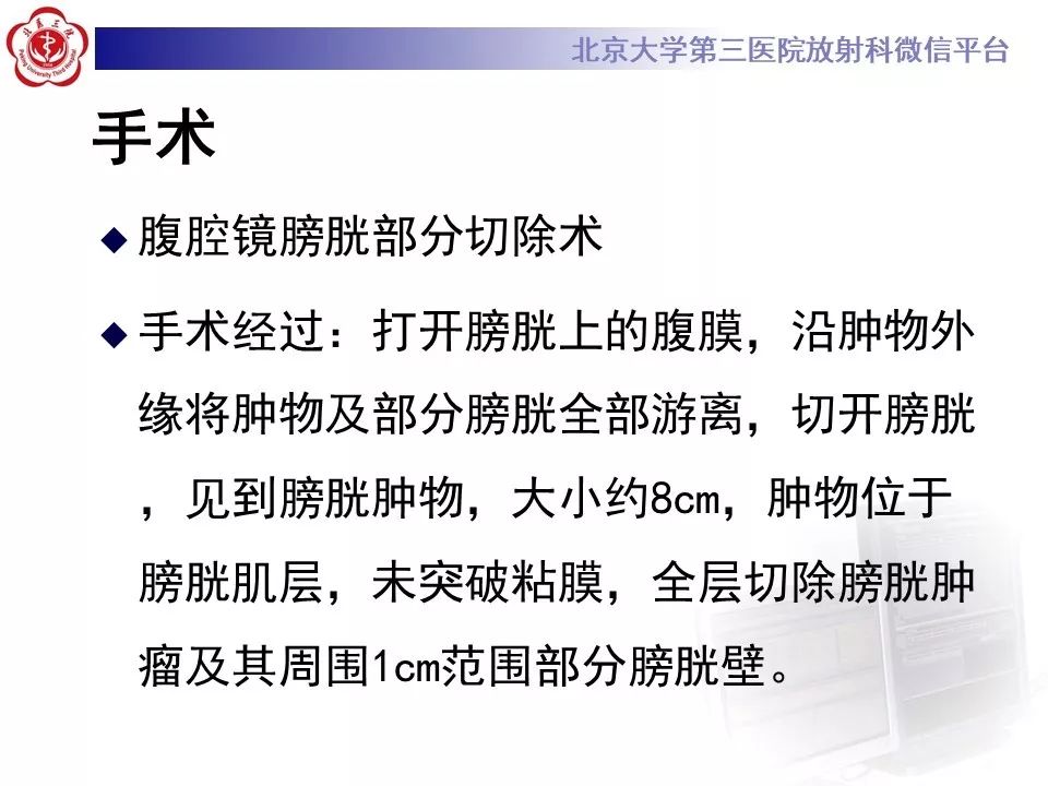 【PPT】膀胱平滑肌瘤