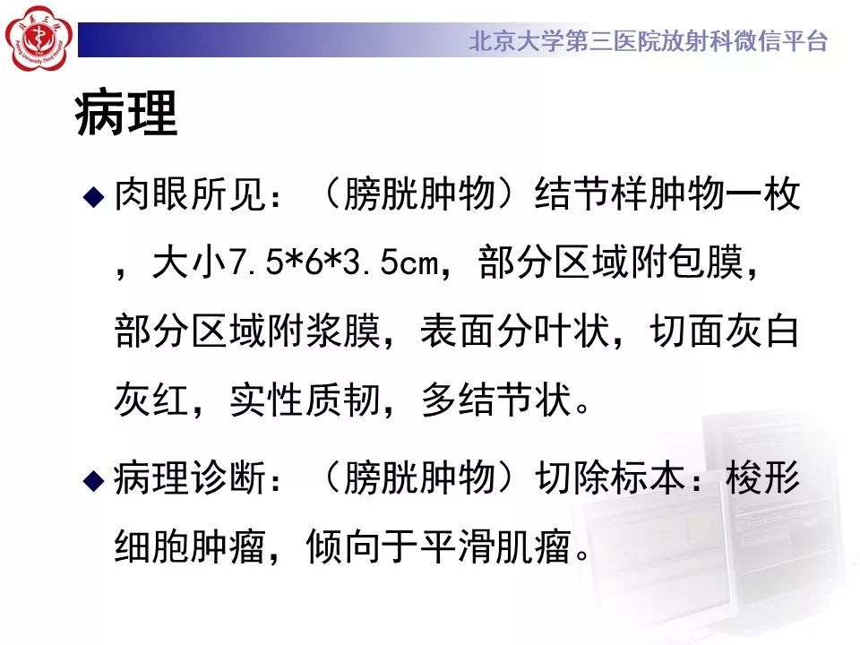 【PPT】膀胱平滑肌瘤