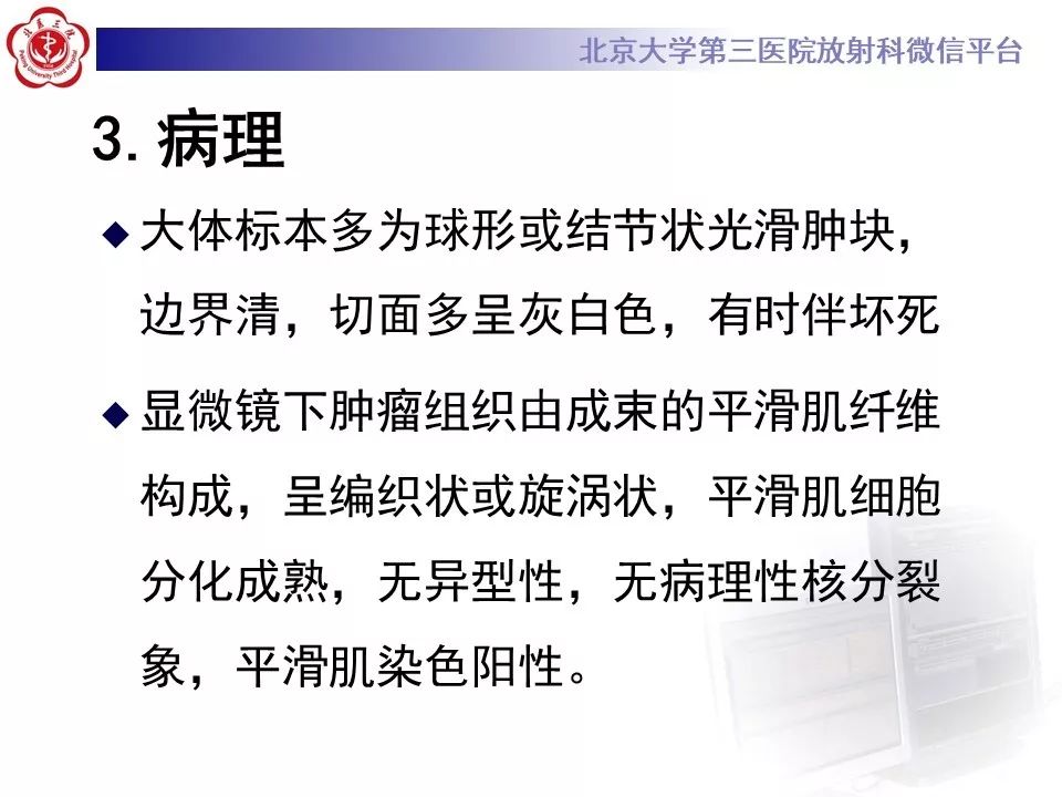 【PPT】膀胱平滑肌瘤