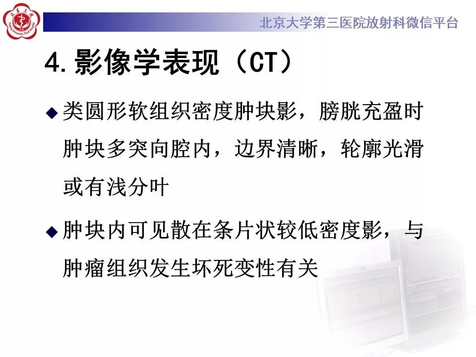 【PPT】膀胱平滑肌瘤