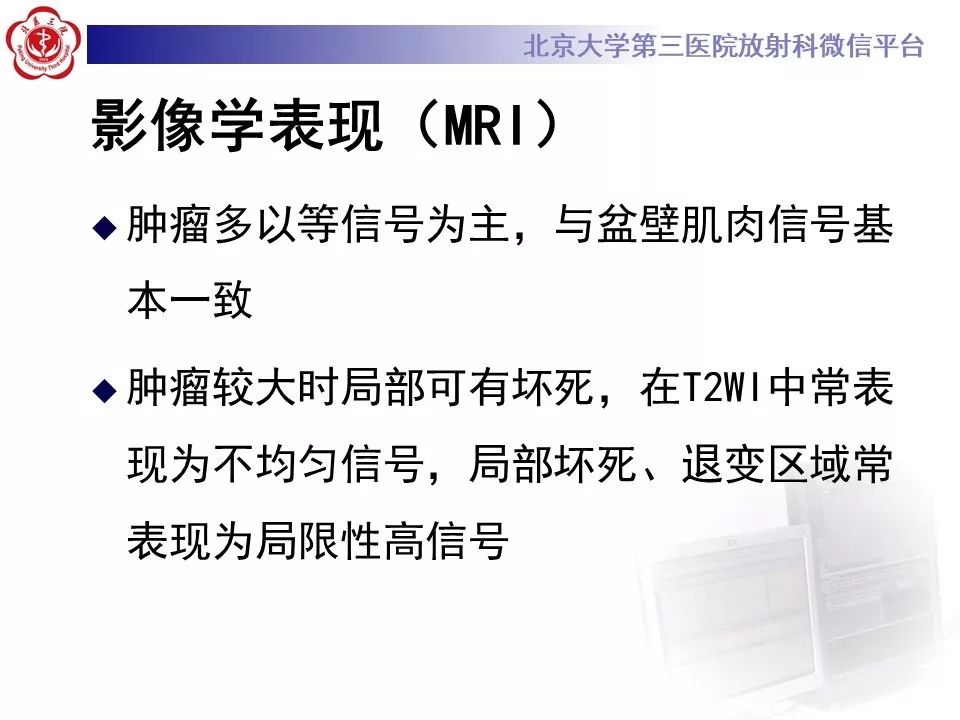 【PPT】膀胱平滑肌瘤