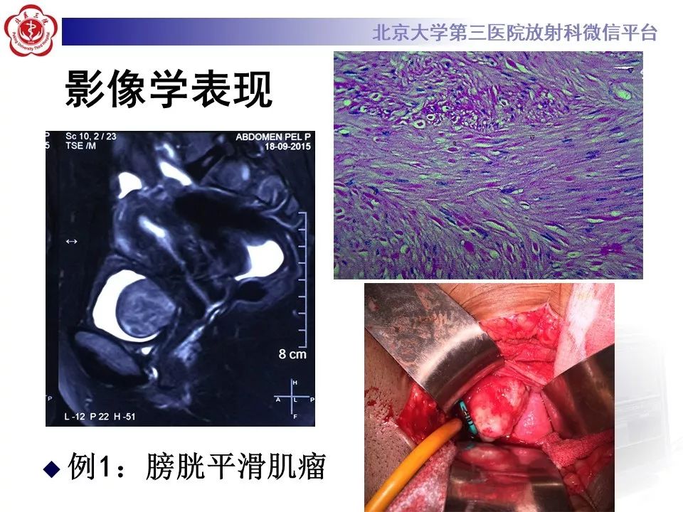 【PPT】膀胱平滑肌瘤