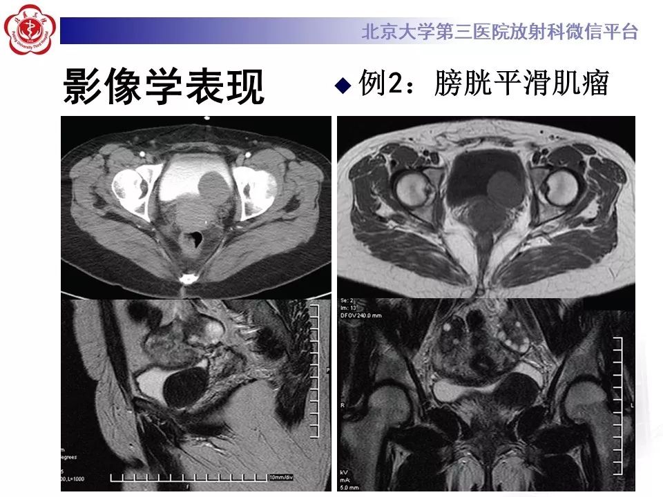 【PPT】膀胱平滑肌瘤