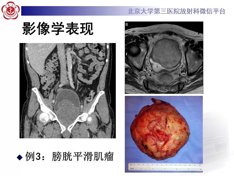 【PPT】膀胱平滑肌瘤