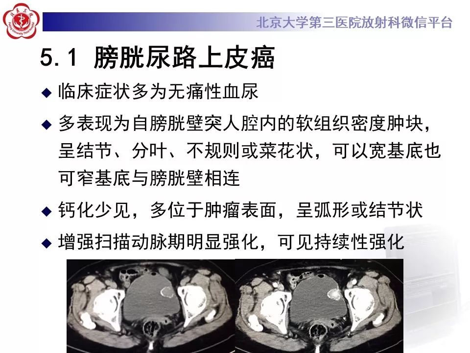【PPT】膀胱平滑肌瘤