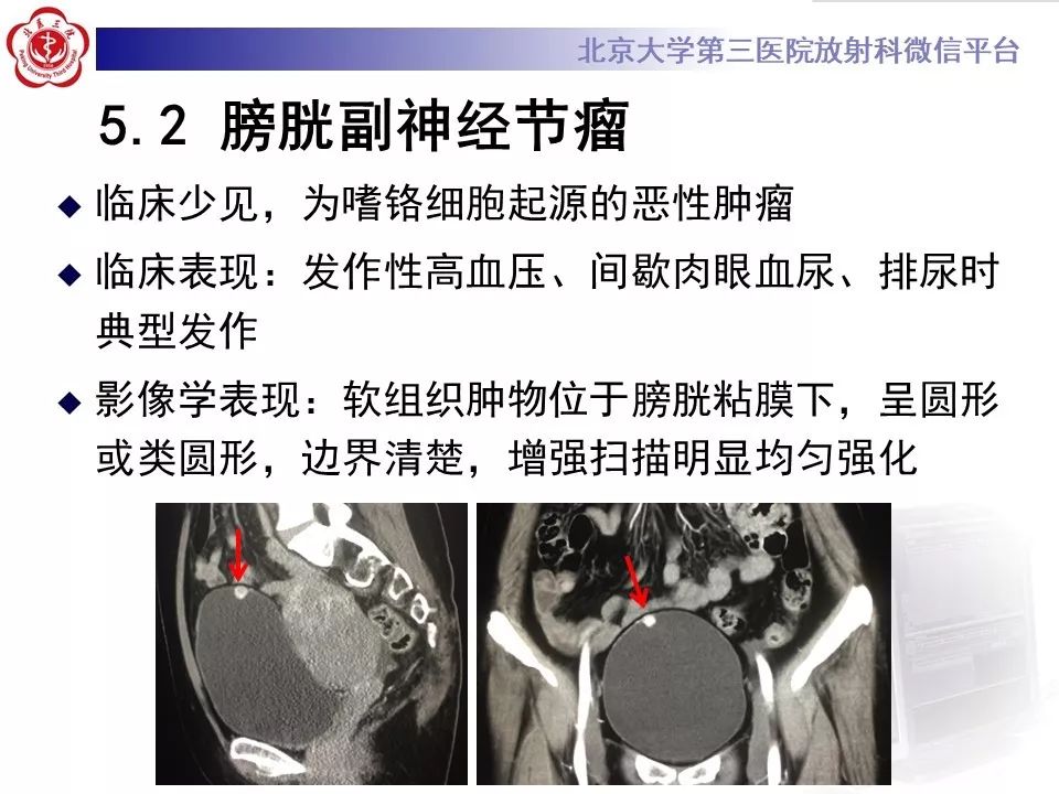 【PPT】膀胱平滑肌瘤