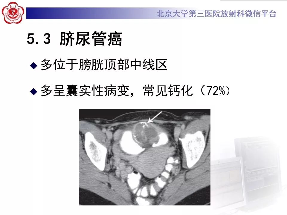 【PPT】膀胱平滑肌瘤