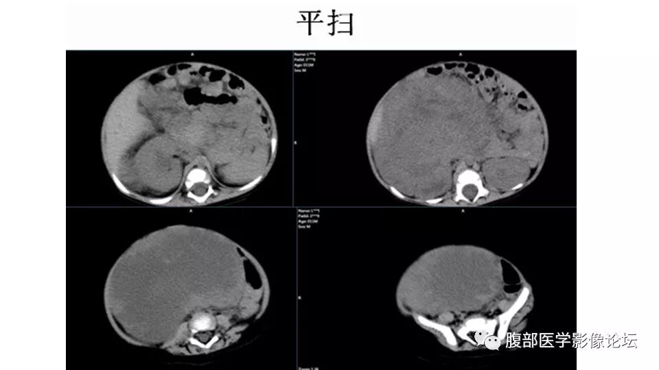 【病例】肾脏透明细胞肉瘤1例CT影像